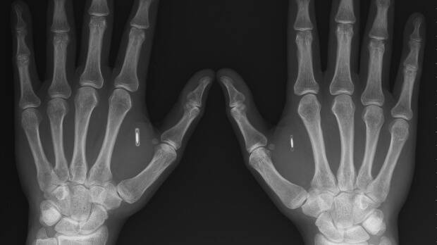 Three Square Market is offering all its employees the option to get a microchip implanted between the thumb and forefinger.  Photo: Supplied

